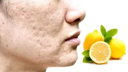 نحوه استفاده از آب لیمو برای آکنه در یک نگاه