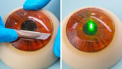 ترفندهای خلاقانه - روش کار جراحی چشم با لیزر