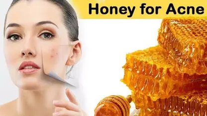نحوه استفاده از عسل برای آکنه مخصوص خانم ها
