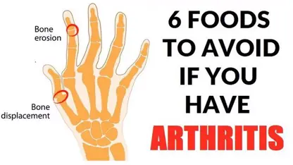 معرفی 6 غذا برای جلوگیری از بیماری آرتروز در یک نگاه
