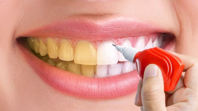 20 روش مفید برای داشتن لبخند هالیوودی و سلامت دندان ها