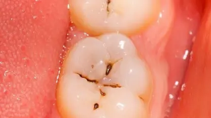 5 عادت بد که باعث اسیب به دندان ها میشود!